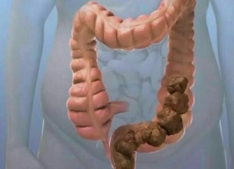 Что такое запор и как от него избавиться